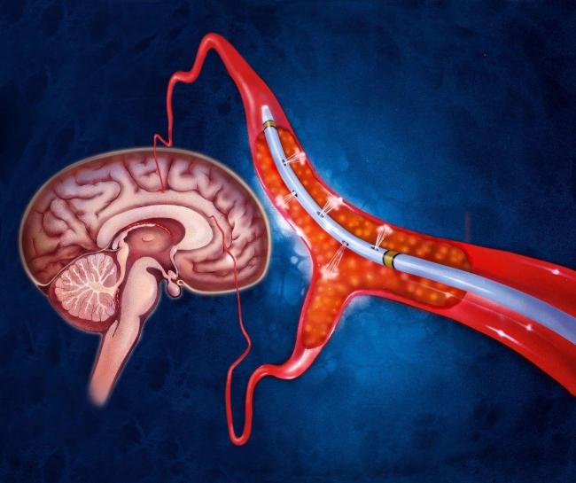 爬楼梯、空腹晨练…错误锻炼不能强身，反而伤身！插图2