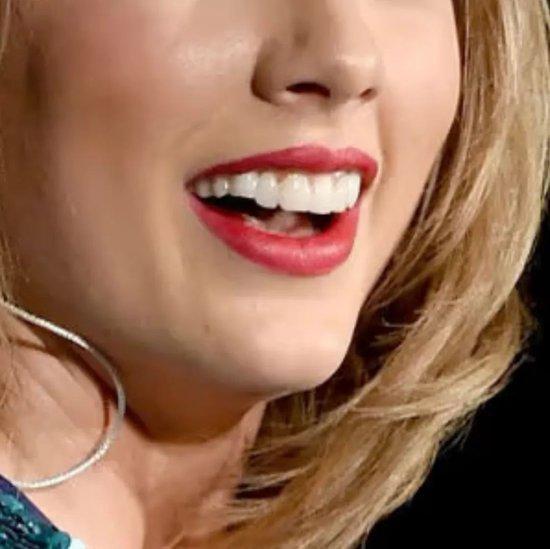 Taylor Swift消失的“小缺牙”，明星都在做的牙齿贴面有多神？插图3