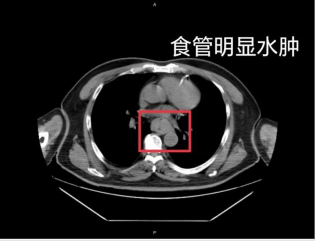 一口”热辣滚烫”男子吐血休克 “趁热吃”可能致癌插图1